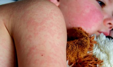 Generan alarma 80 posibles casos de sarampión en Tabasco